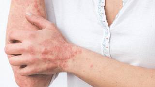 Comment traiter la dermatite atopique ?